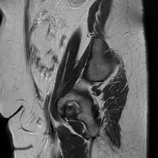 File:Adult granulosa cell tumor of the ovary (Radiopaedia 64991-73953 Sagittal T2 5).jpg