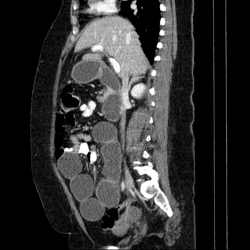 File:Afferent loop syndrome - secondary to incarcerated trocar site hernia (Radiopaedia 82959-97305 Sagittal C+ portal venous phase 93).jpg
