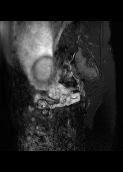 File:Aggressive angiomyxoma of the pelvis and perineum (Radiopaedia 59162-66479 Sagittal T2 fat sat 20).jpg