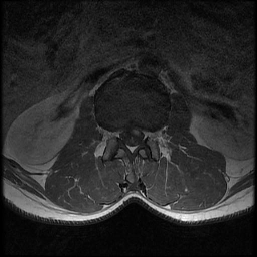 File:Aggressive vertebral hemangioma with pathological fracture (Radiopaedia 69528-79411 Axial T1 C+ 9).jpg
