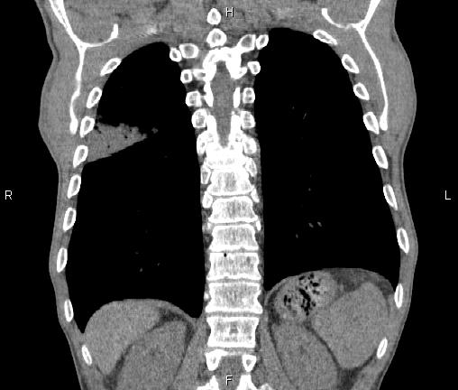 Air bronchogram in pneumonia (Radiopaedia 85719-101512 Coronal non-contrast 46).jpg