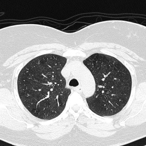 File:Air trapping in small airway disease (Radiopaedia 61685-69694 Axial lung window 47).jpg