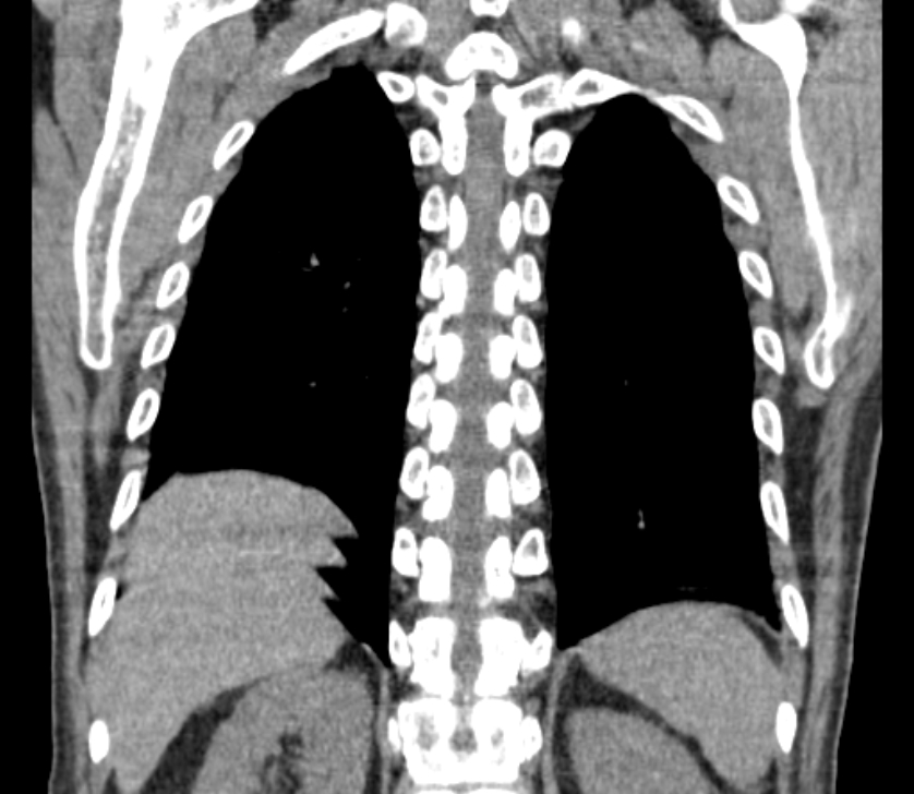 Airway foreign body in adult (Radiopaedia 85907-101779 Coronal liver window 220).jpg