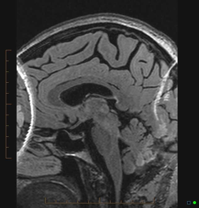 Aliasing artifact causing a spurious cerebellar lesion (Radiopaedia 48783-53810 Sagittal FLAIR 39).jpg