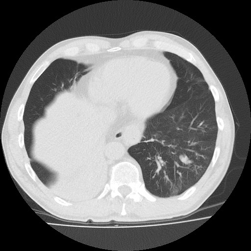 File:Allergic bronchopulmonary aspergillosis (ABPA) (Radiopaedia 60594-68313 Axial lung window 45).jpg