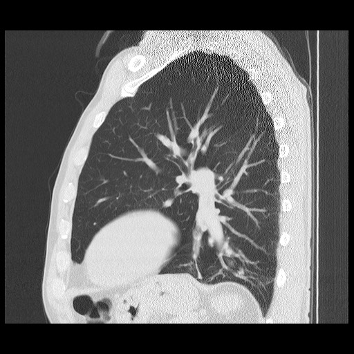 Allergic bronchopulmonary aspergillosis (ABPA) (Radiopaedia 60594-68313 Sagittal lung window 19).jpg