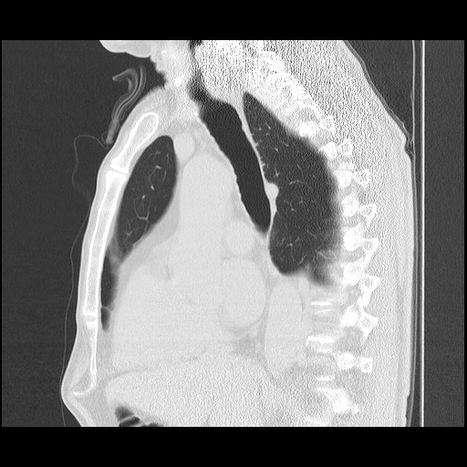 Allergic bronchopulmonary aspergillosis (ABPA) (Radiopaedia 60594-68313 Sagittal lung window 32).jpg