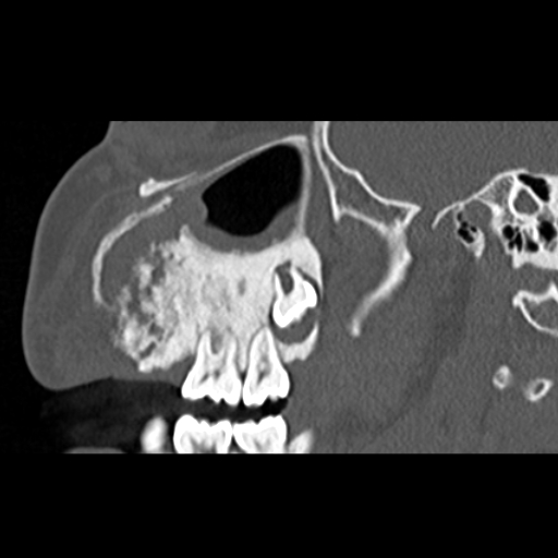 File:Ameloblastic fibro-odontoma (Radiopaedia 18843-18780 bone window 10).jpg
