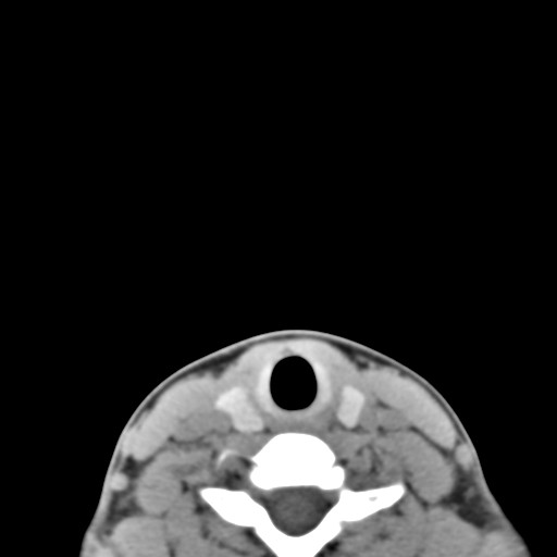 File:Ameloblastoma (Radiopaedia 26645-26793 Axial C+ delayed 1).jpg