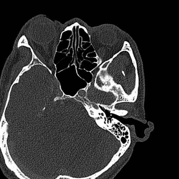 Ameloblastoma (Radiopaedia 51921-57766 Axial bone window 164).jpg