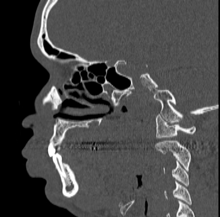 Ameloblastoma (Radiopaedia 77750-89997 Sagittal bone window 7).jpg
