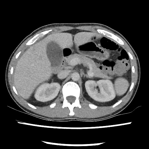 Amoebic liver abscesses (Radiopaedia 55536-62010 A 32).jpg