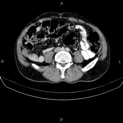Ampullary adenocarcinoma (Radiopaedia 86093-102032 A 37).jpg