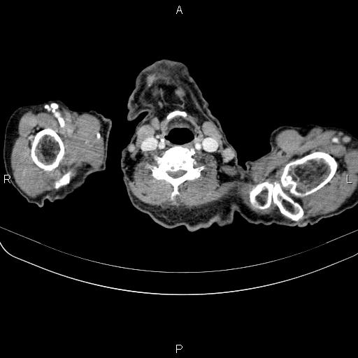 Ampullary adenocarcinoma (Radiopaedia 86093-102033 B 4).jpg