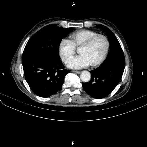 Ampullary adenocarcinoma (Radiopaedia 86093-102033 B 40).jpg