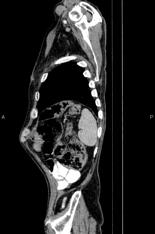 Ampullary adenocarcinoma (Radiopaedia 86093-102033 E 82).jpg
