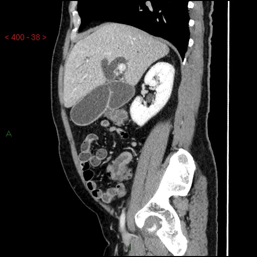 Ampullary carcinoma (Radiopaedia 56396-63056 D 37).jpg