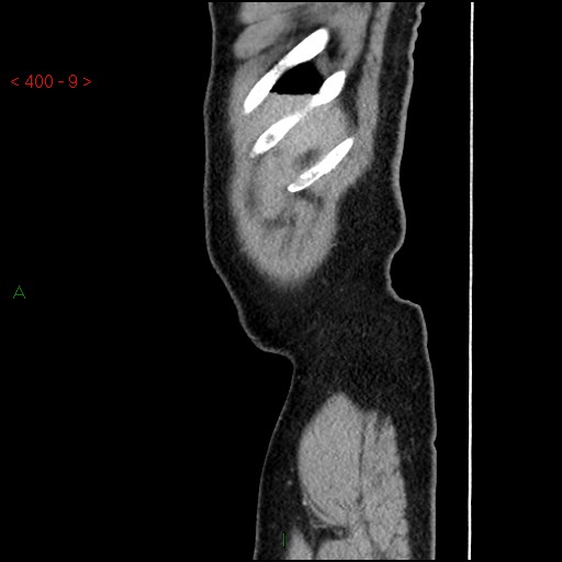 File:Ampullary carcinoma (Radiopaedia 56396-63056 D 8).jpg