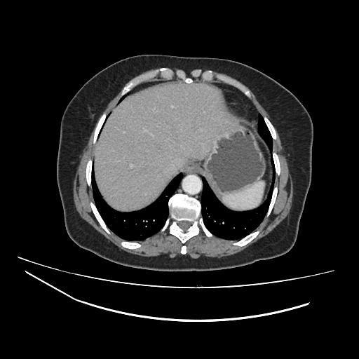 Ampullary tumor (Radiopaedia 60333-67998 A 5).jpg