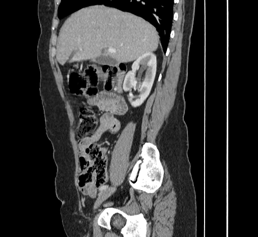 File:Ampullary tumor (Radiopaedia 60333-67998 C 17).jpg