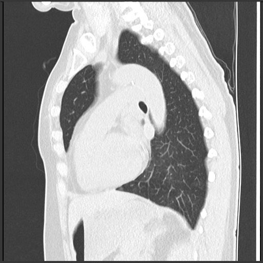 Amyloidosis - bronchial and diffuse nodular pulmonary involvement (Radiopaedia 60156-67744 F 34).jpg