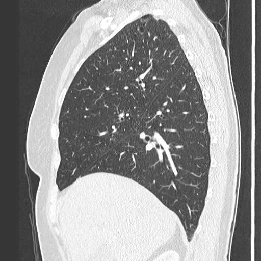 Amyloidosis - bronchial and diffuse nodular pulmonary involvement (Radiopaedia 60156-67745 Sagittal lung window 28).jpg