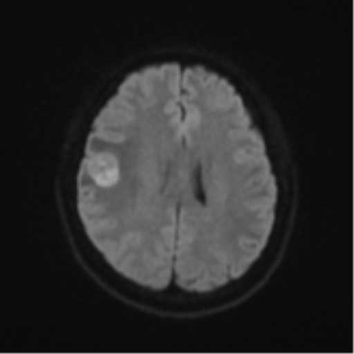 Anaplastic astroblastoma (Radiopaedia 55666-62194 Axial DWI 47).png