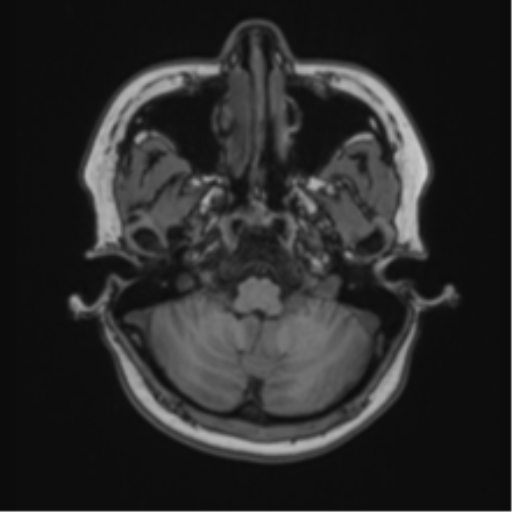 Anaplastic astroblastoma (Radiopaedia 55666-62194 Axial T1 14).png
