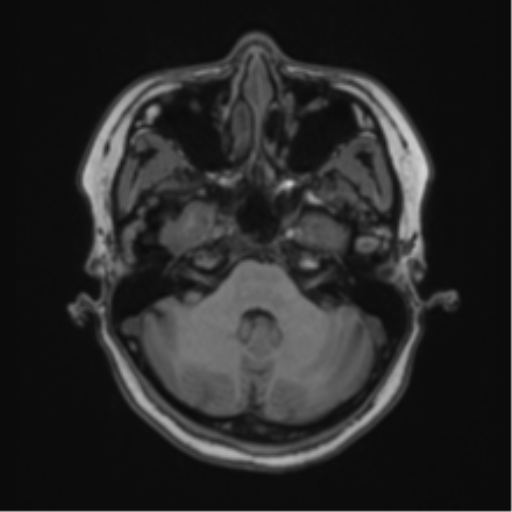 Anaplastic astroblastoma (Radiopaedia 55666-62194 Axial T1 18).png