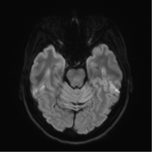 Anaplastic astrocytoma - thalamic glioma (Radiopaedia 59709-67115 Axial DWI 47).png