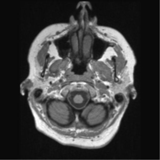 File:Anaplastic astrocytoma IDH wild-type (pseudoprogression) (Radiopaedia 42209-45276 Axial T1 19).png