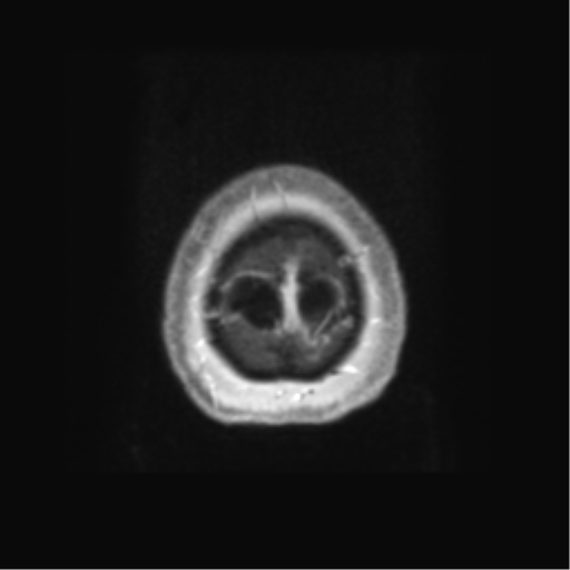 Anaplastic astrocytoma IDH wild-type (pseudoprogression) (Radiopaedia 42209-45279 Axial T1 C+ 138).png