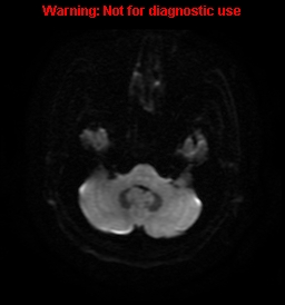File:Anaplastic ganglioglioma (Radiopaedia 44921-48831 Axial DWI 5).jpg