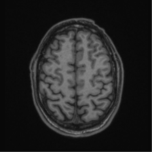 Anaplastic oligodendroglioma with skull fracture (Radiopaedia 74831-85845 Axial T1 52).png