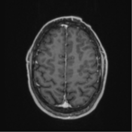 Anaplastic oligodendroglioma with skull fracture (Radiopaedia 74831-85845 Axial T1 C+ fat sat 52).png