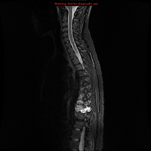 File:Aneurysmal bone cyst (Radiopaedia 9419-10103 Sagittal T2 7).jpg