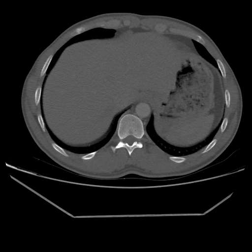 File:Aneurysmal bone cyst - rib (Radiopaedia 82167-96220 Axial bone window 215).jpg
