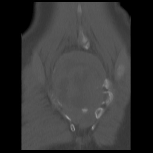 File:Aneurysmal bone cyst - sacrum (Radiopaedia 65190-74195 Coronal bone window 13).jpg