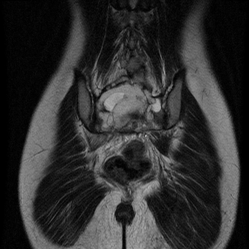 File:Aneurysmal bone cyst - sacrum (Radiopaedia 65190-74196 Coronal T2 9).jpg