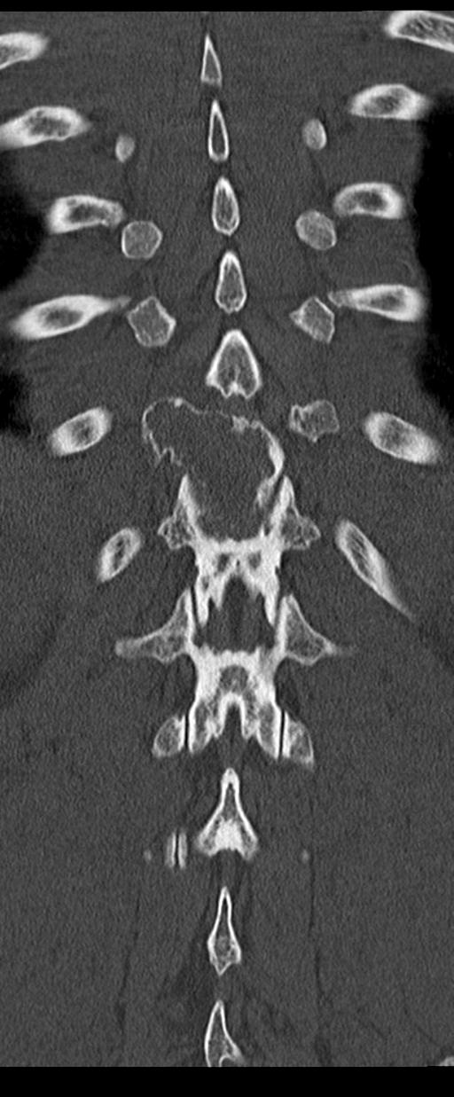 Aneurysmal bone cyst T11 (Radiopaedia 29294-29721 Coronal bone window 49).jpg