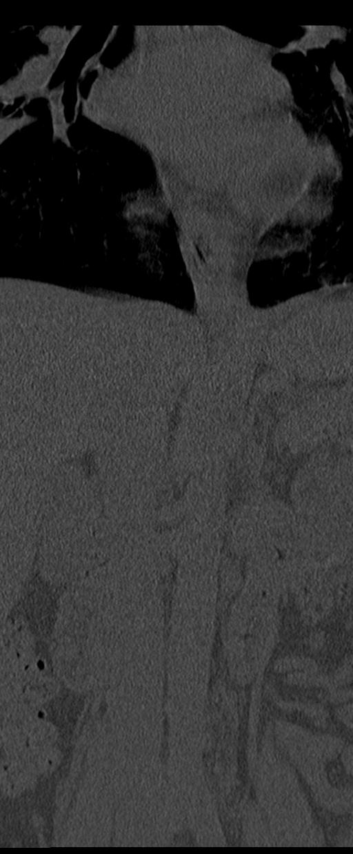 Aneurysmal bone cyst T11 (Radiopaedia 29294-29721 Coronal bone window 5).jpg