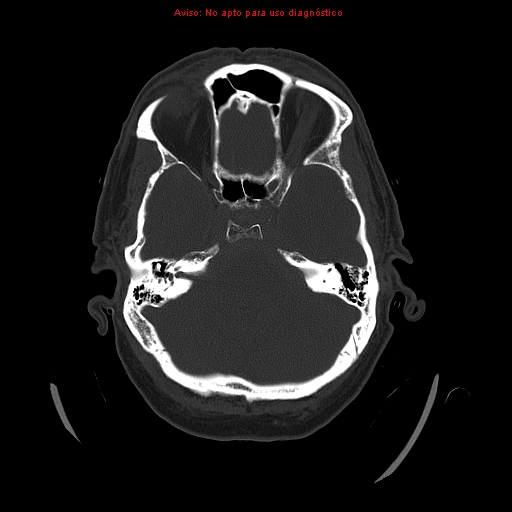 File:Aneurysmal subarachnoid hemorrhage (Radiopaedia 24740-24997 bone window 11).jpg