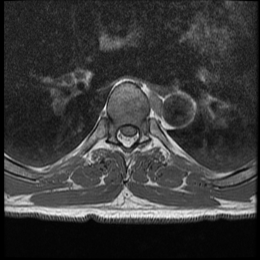 File:Angiolipoma - thoracic spine (Radiopaedia 28242-28479 Axial T1 9).jpg