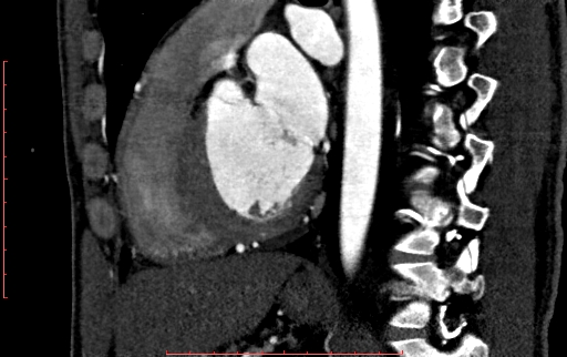 File:Anomalous left coronary artery from the pulmonary artery (ALCAPA) (Radiopaedia 70148-80181 C 144).jpg