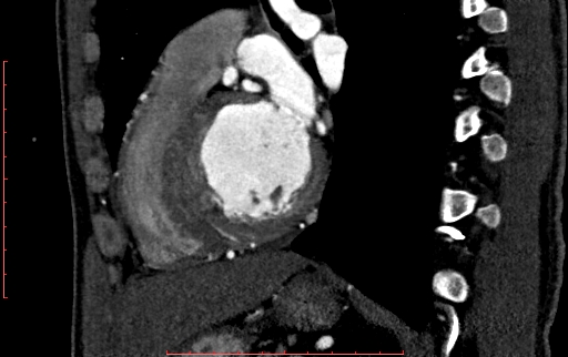File:Anomalous left coronary artery from the pulmonary artery (ALCAPA) (Radiopaedia 70148-80181 C 159).jpg