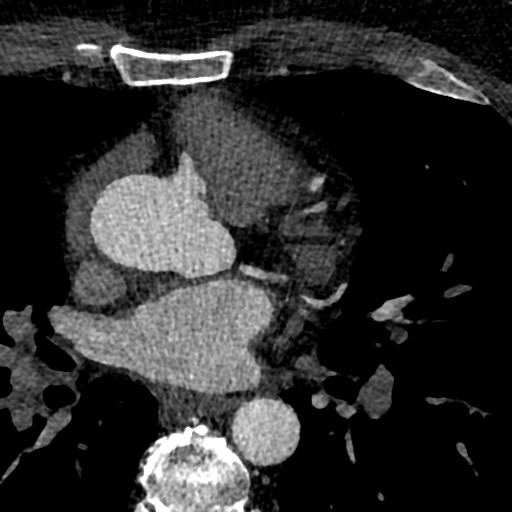 File:Anomalous origin of the left coronary artery with malignant course (Radiopaedia 77842-90126 C 45).jpeg
