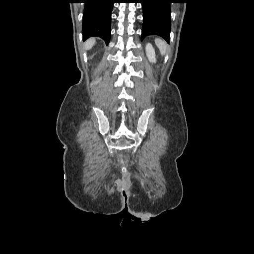 Anorectal carcinoma (Radiopaedia 44413-48064 B 77).jpg