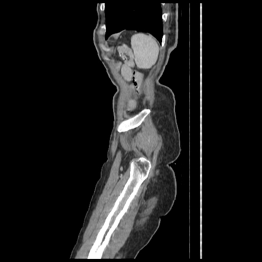 Anorectal carcinoma (Radiopaedia 44413-48064 C 103).jpg