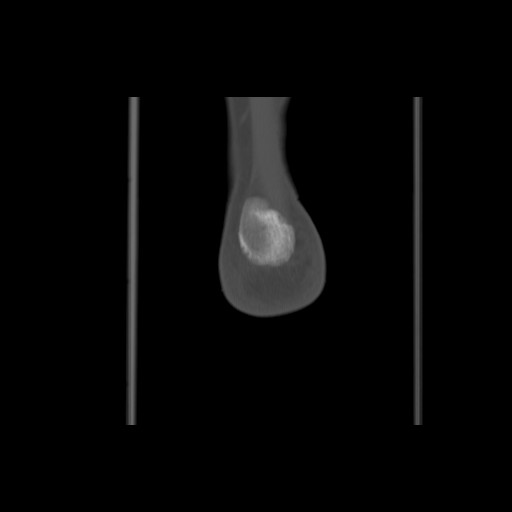 File:Anterior calcaneal process fracture (Radiopaedia 82590-96762 Coronal bone window 73).jpg
