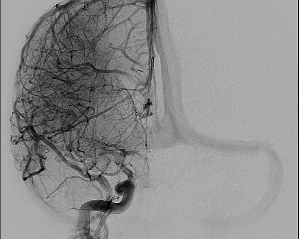 File:Anterior cerebral artery aneurysm (Radiopaedia 80683-94128 A 8).jpg
